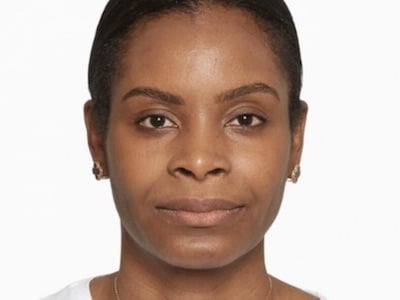 Sculptra Facial After