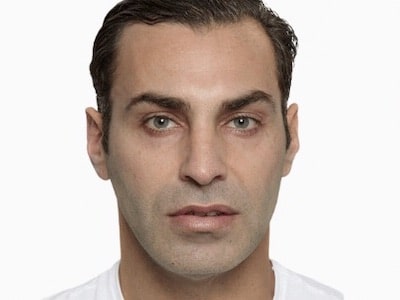 Sculptra Facial After