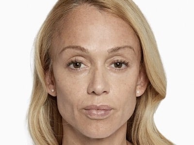 Sculptra Facial After