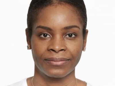 Sculptra Facial Before