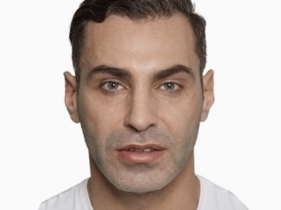 Sculptra Facial Before