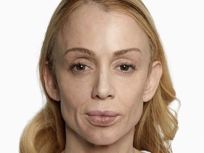 Sculptra Facial Before